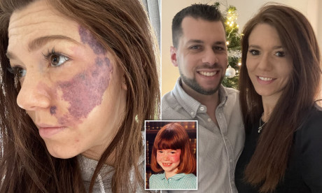 Surrey Woman Was So Badly Bullied Over Birthmark That She Won T Let Fiance See Her Without Make Up Daily Mail Online